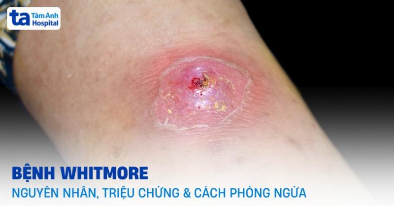 Hình ảnh một người nhẹ nhàng cho chó uống thuốc dạng viên, thể hiện việc chăm sóc và tuân thủ điều trị